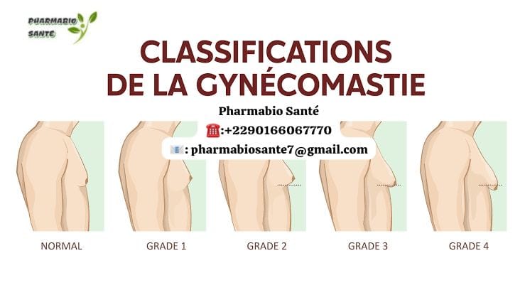 Soigner la gynécomastie naturellement