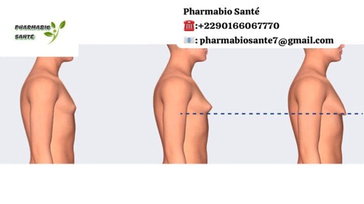 Remède de Grand-Mère pour Gynécomastie