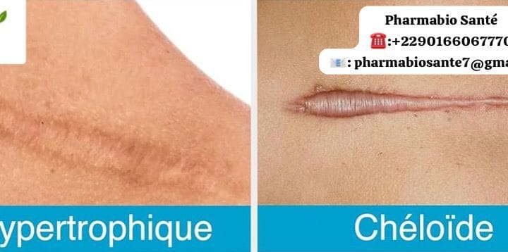 Avis traitement naturel chéloïde