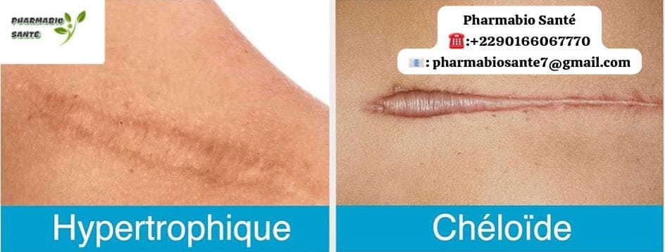 Avis traitement naturel chéloïde