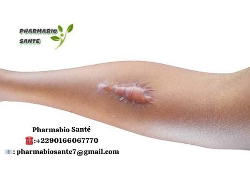 Chéloïde peut Disparaître Naturellement