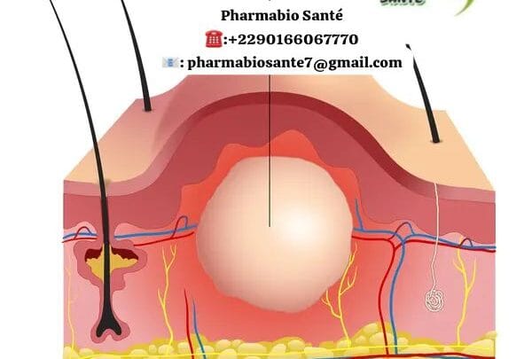 Éviter chéloïde après abcès