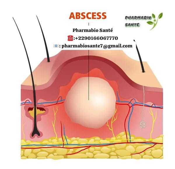 Éviter chéloïde après abcès