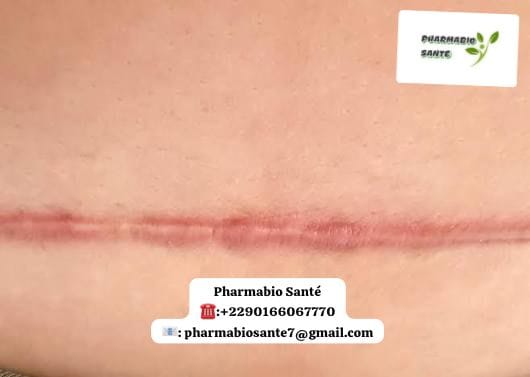 Aloe vera chéloïde