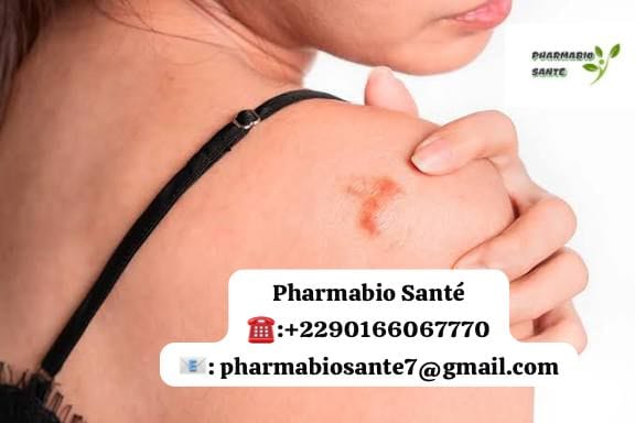 Remède de grand-mère pour chéloïde