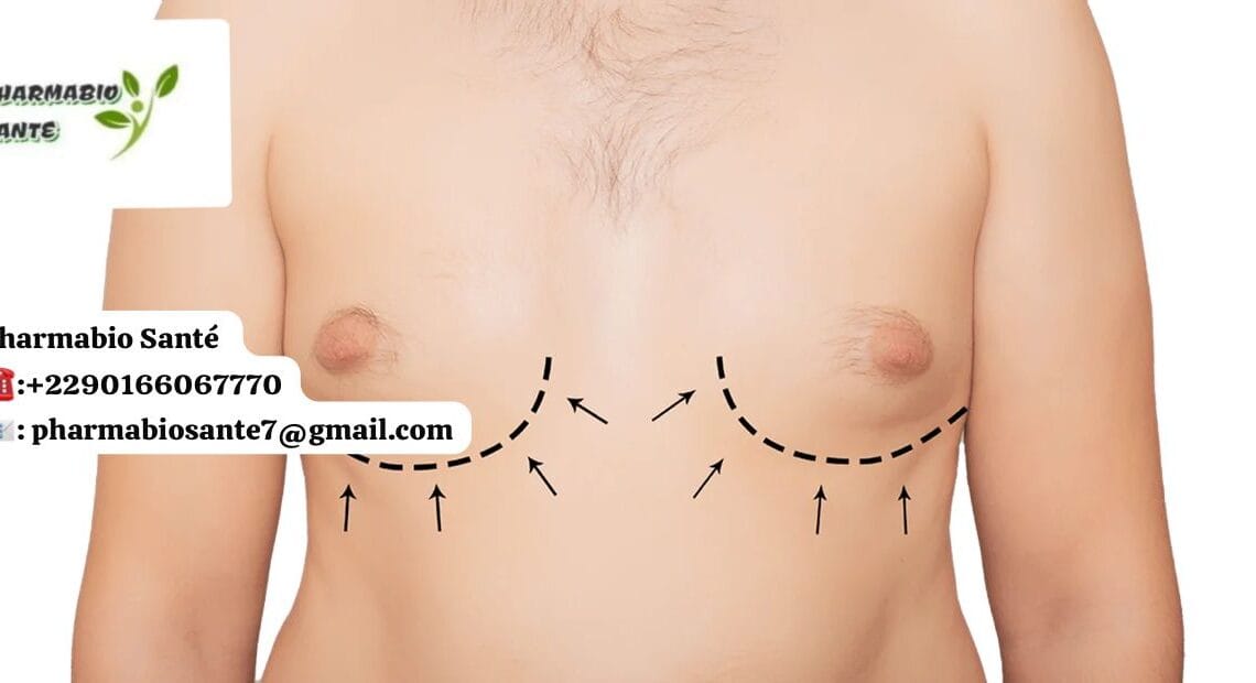 Gynécomastie traitement naturel efficace