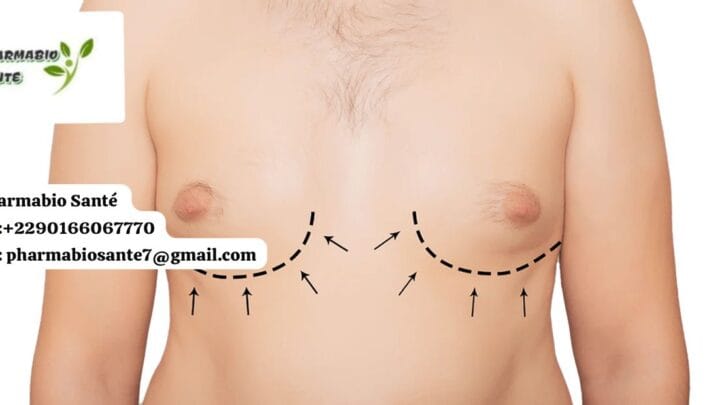 Gynécomastie traitement naturel efficace