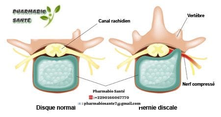 Guérir hernie discale sans chirurgie