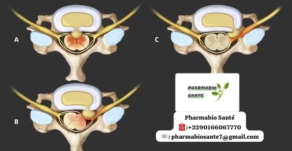 hernie discale cervicale traitement naturel