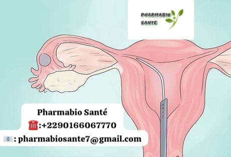 Guérir trompe bouchée sans chirurgie