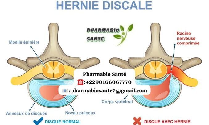 Remède naturel hernie discale lombaire