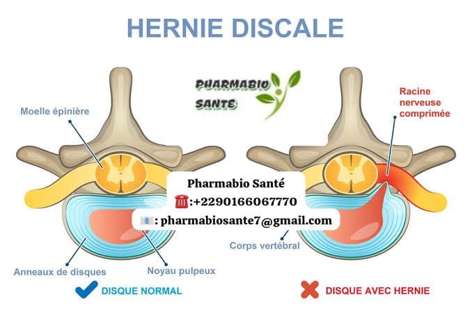 Remède naturel hernie discale lombaire