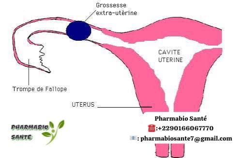 Grossesse avec une trompe bouchée