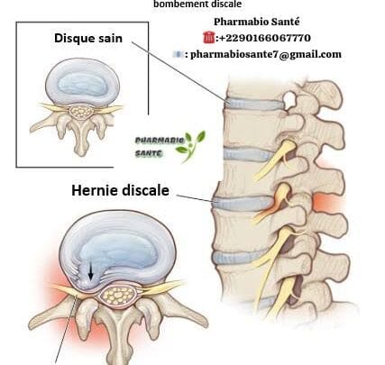 Soigner hernie discale naturellement