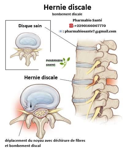 Soigner hernie discale naturellement