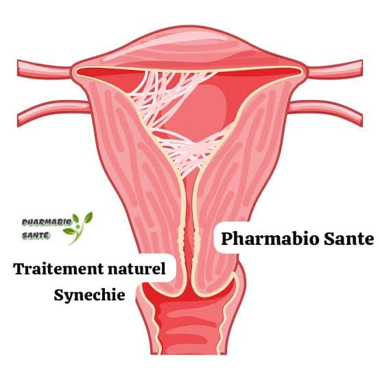 Synéchie Utérine Traitement Naturel