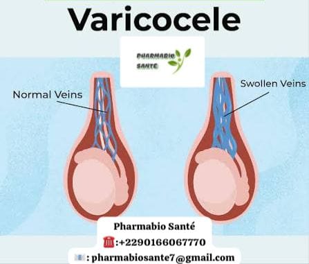 Remède efficace varicocèle