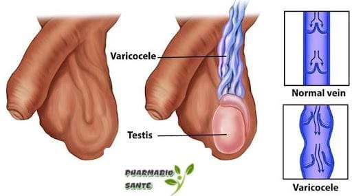 Varicocèle traitement naturel