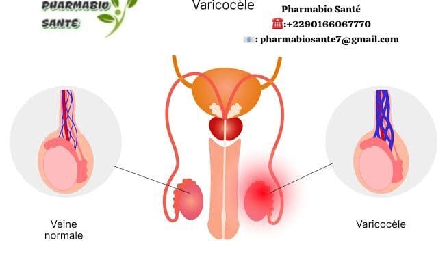 Varicocèle Douleur au testicule