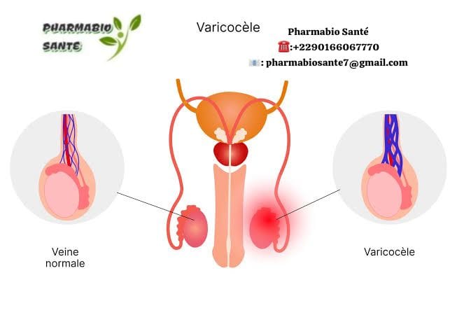 Varicocèle Douleur au testicule
