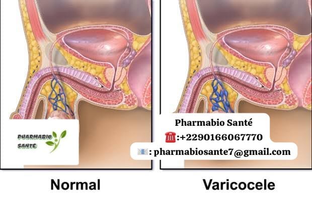 Varicocèle et Fertilité