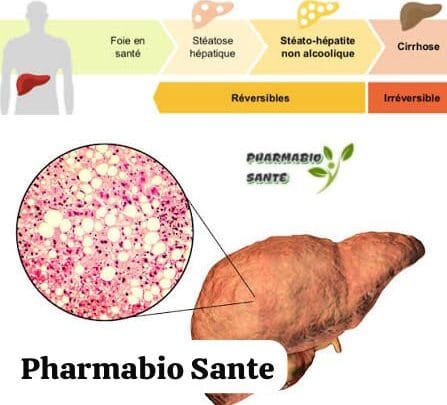 Stéatose Hépatique Grade Symptômes