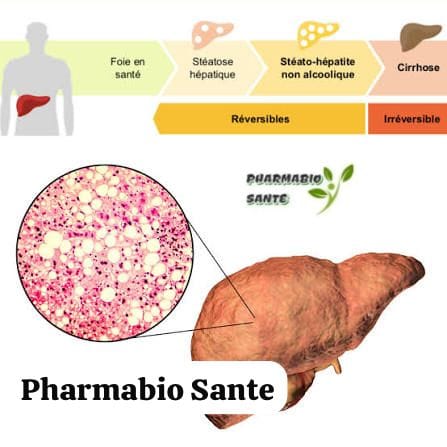 Stéatose Hépatique Grade Symptômes