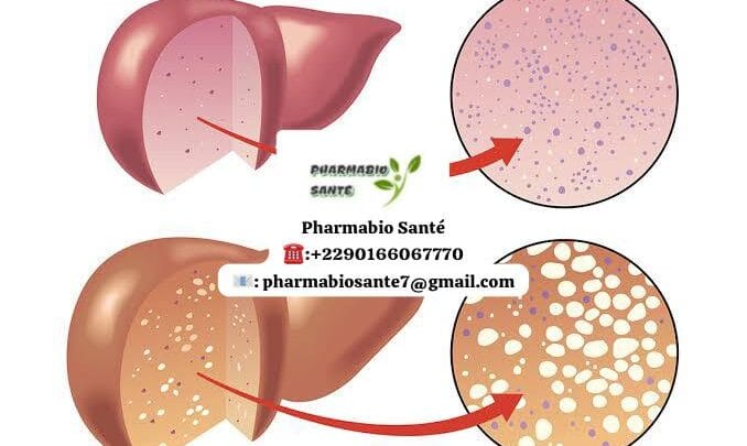 Stéatose Hépatique Traitement Naturel