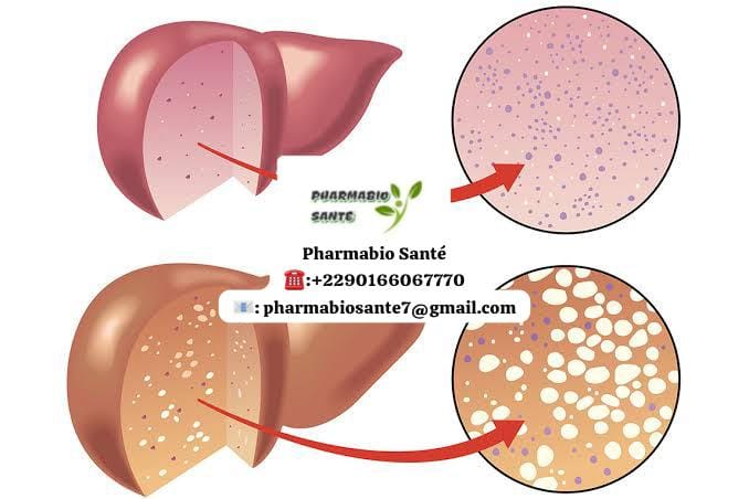 Stéatose Hépatique Traitement Naturel