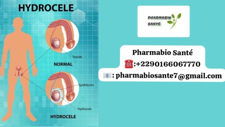 Traitement naturel hydrocèle