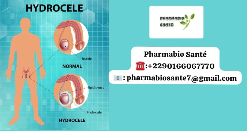Traitement naturel hydrocèle