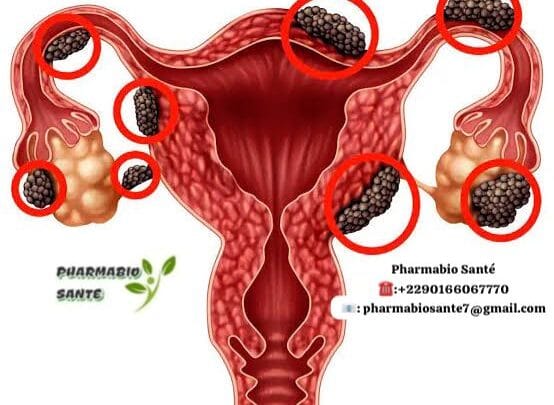 Endométriose et Symptômes