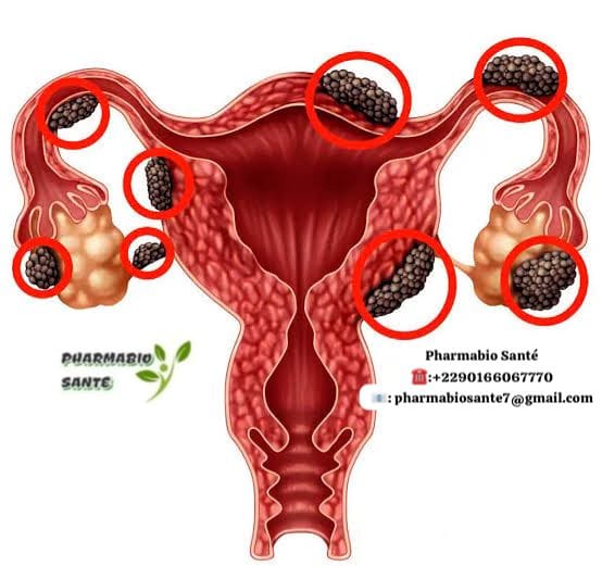 Endométriose et Symptômes