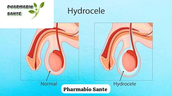 Soigner une hydrocèle naturellement