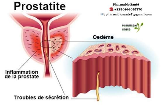 Comment soigner une prostatite naturellement