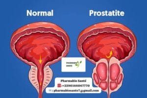 Remède de grand-mère pour prostatite