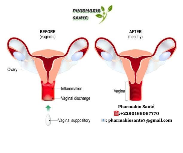 Remèdes contre les Mycoses