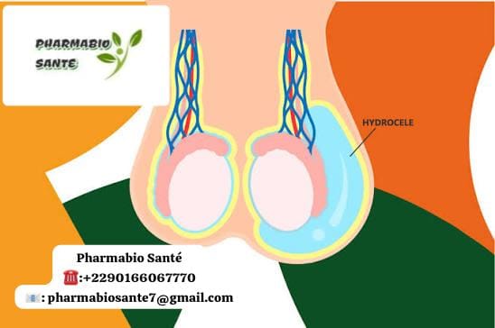 Hydrocèle Définition Traitements Naturels