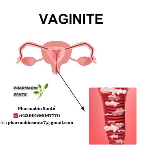 Traitements Naturels Mycose Vaginale