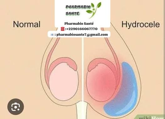 Hydrocèle Causes Traitement Naturel