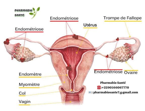 Endométriose Ovarienne Traitement Naturel