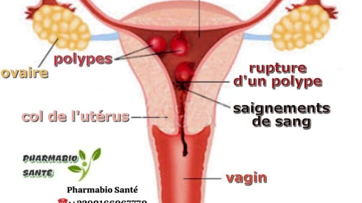 Métrorragie Causes Traitement Naturel