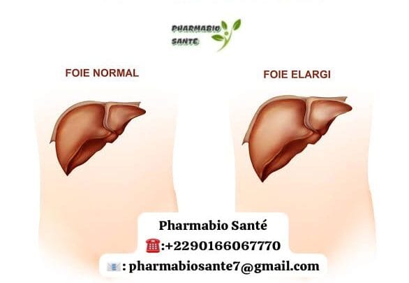 Hépatomégalie Foie Gonflé Traitement