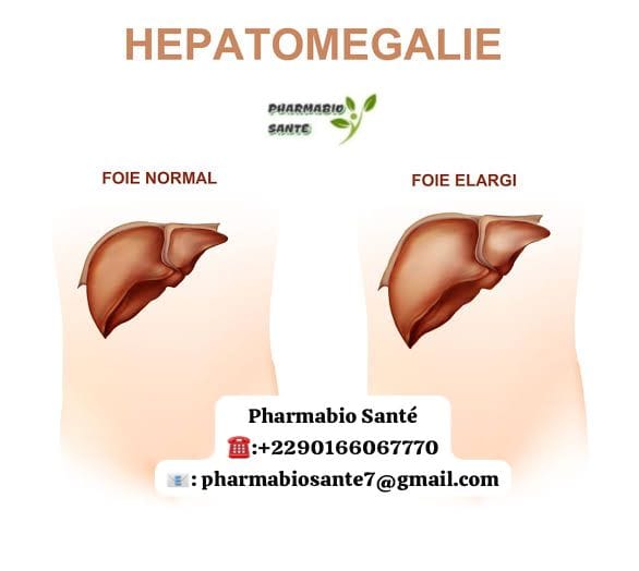 Hépatomégalie Foie Gonflé Traitement
