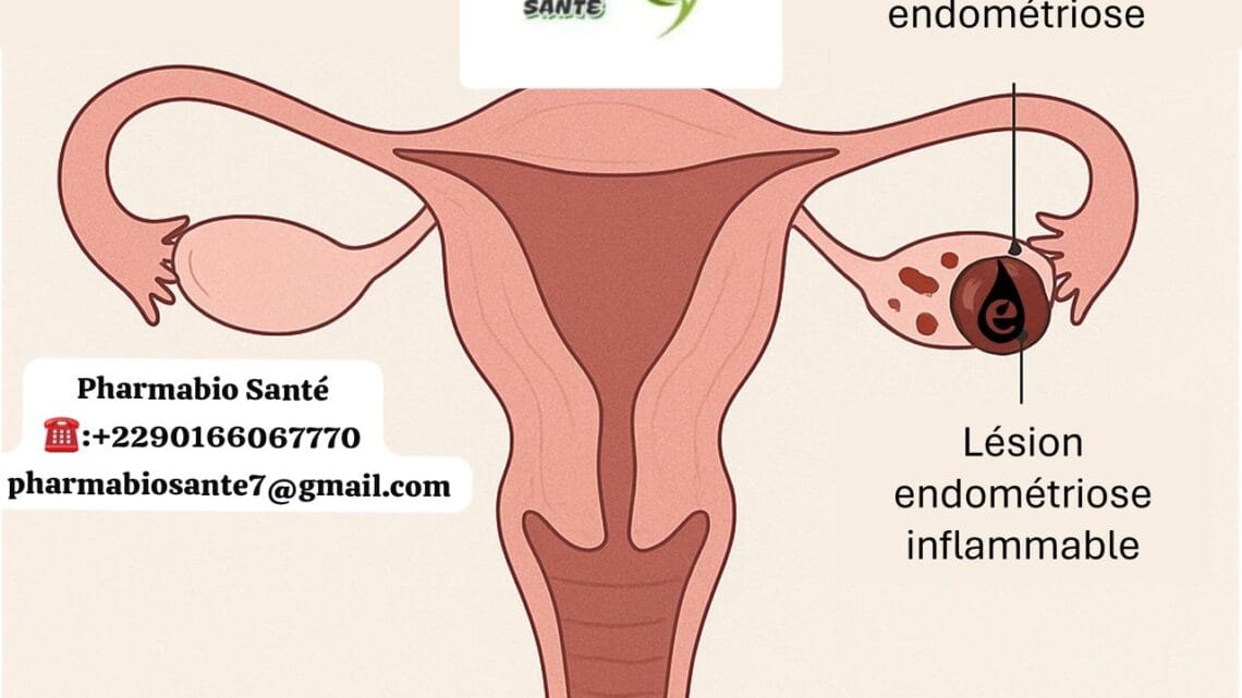 Kyste Endométriosique Solutions Naturelles