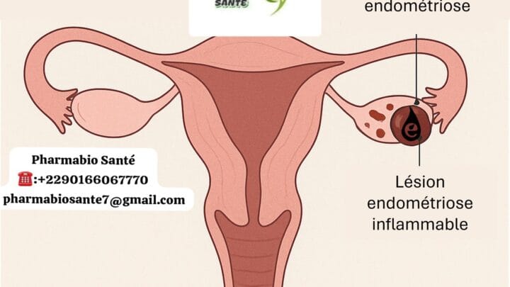 Kyste Endométriosique Solutions Naturelles