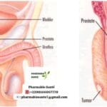 Traitement Naturel de la Prostatite
