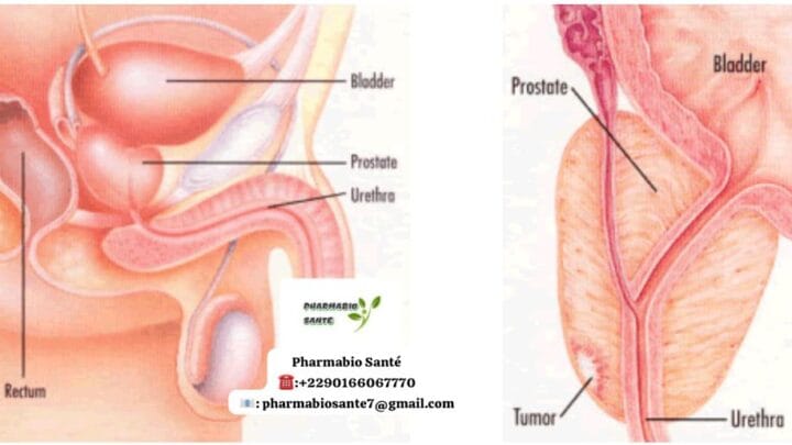 Traitement Naturel de la Prostatite