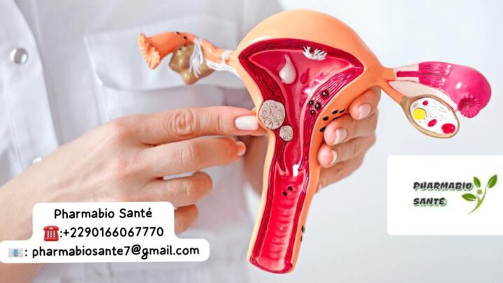 Myomes fibromes solution naturelle