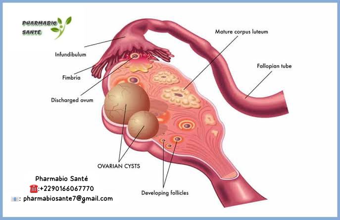 Huiles Essentielles Kystes Ovariens